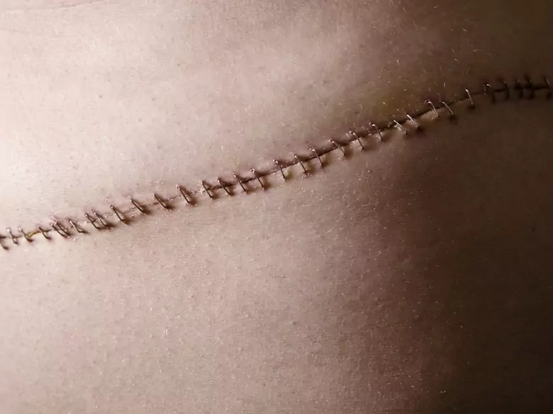 ¿Pueden evitarse las cicatrices?