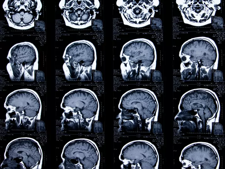 Quiste pineal - causas, síntomas, diagnóstico, tratamiento