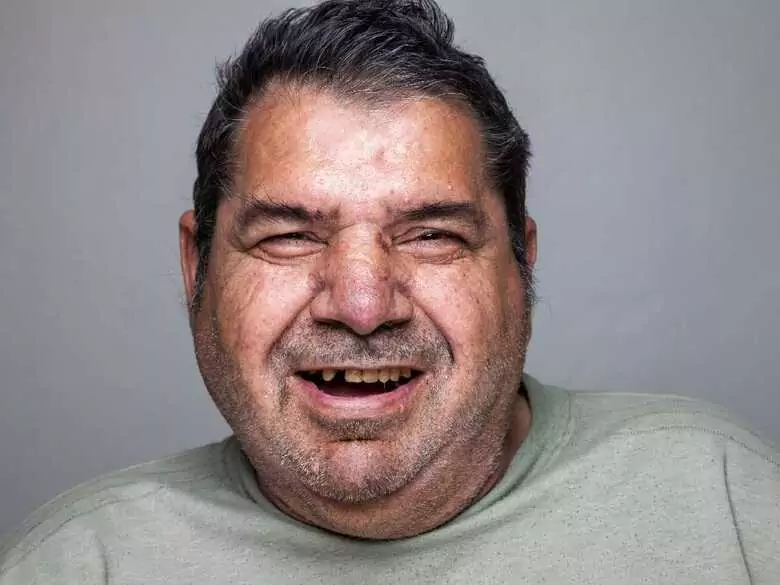 ¿Por qué la obesidad puede aumentar el riesgo de enfermedad periodontal?