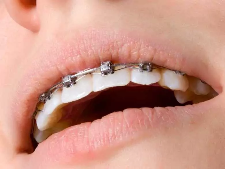 Brackets molestos