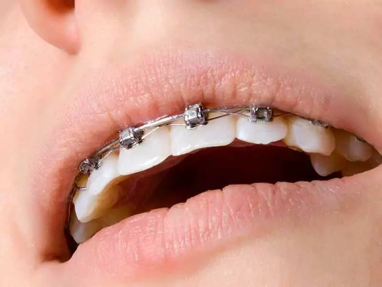 Diagnóstico de la maloclusión