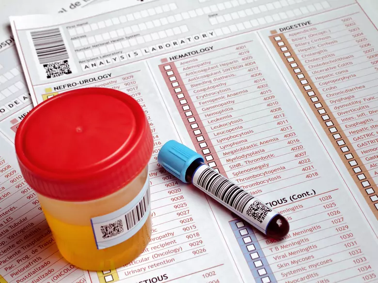 Pseudohipoparatiroidismo - causas, síntomas, diagnóstico, tratamiento