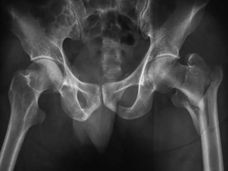 Fragilidad ósea en mujeres peri y postmenopáusicas - causas, síntomas, diagnóstico, tratamiento