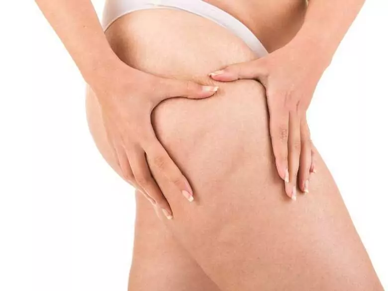 Lipodemia - enfermedad de las "piernas gordas