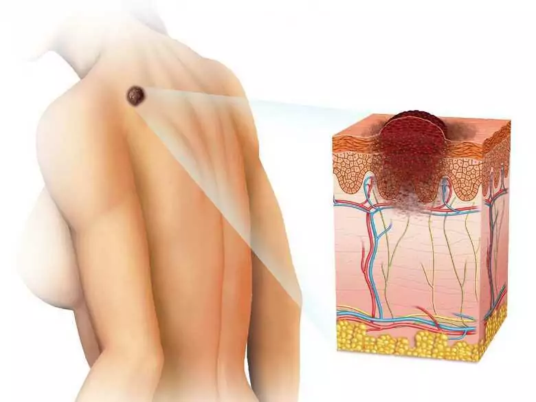 Cáncer de piel y afecciones precancerosas