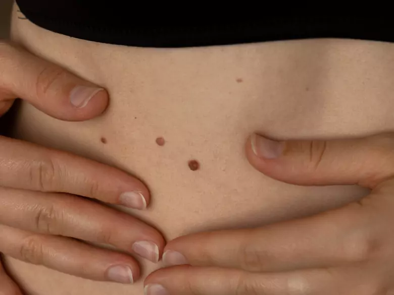 Nueva vía para que los científicos detecten el cáncer de piel