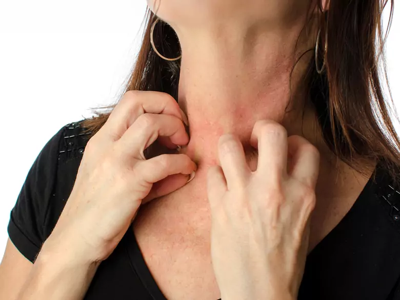 Epidemiología de la alergia de contacto al níquel