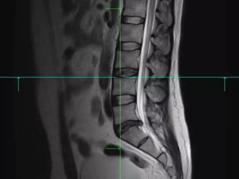 Discopatía lumbar