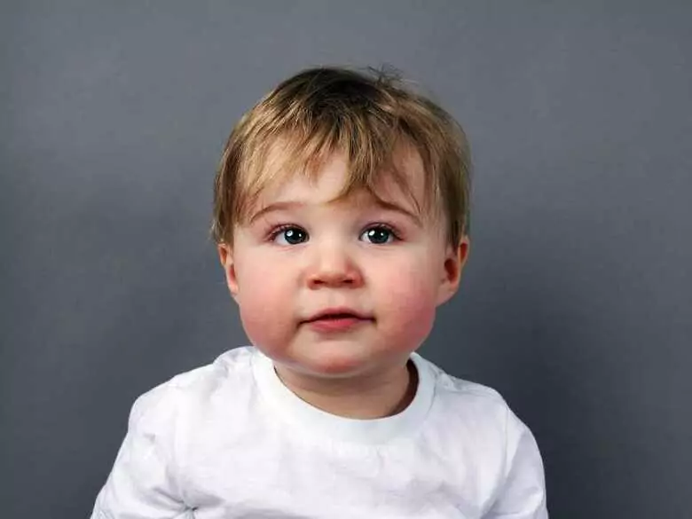 Impétigo infeccioso - causas, síntomas, diagnóstico, tratamiento