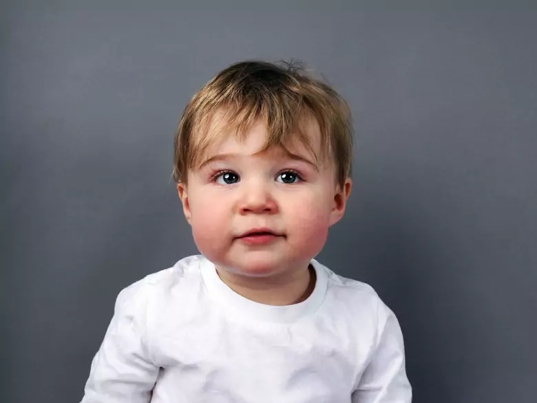 ¿La dieta ayuda a aliviar los síntomas de la dermatitis atópica?