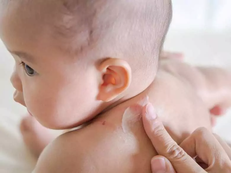 Eccema infantil: el impacto de la lactancia materna