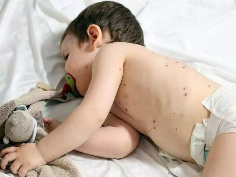 Sarampión: ¿corremos el riesgo de una epidemia?