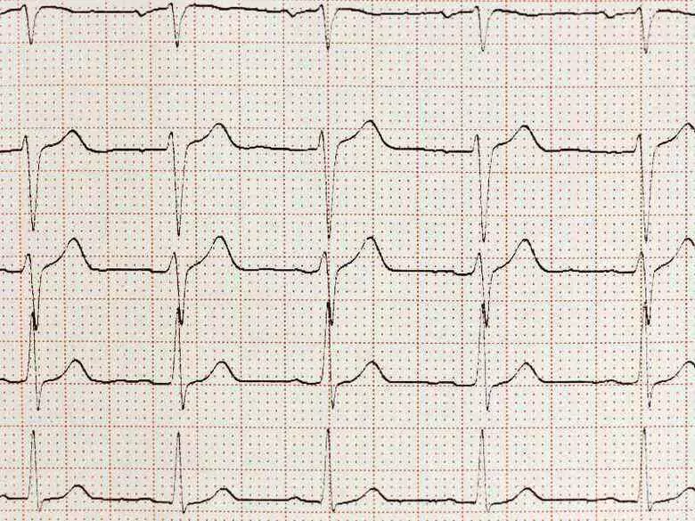 Diagnóstico mediante pruebas de ECG