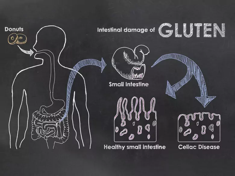 Correlación entre el gluten y la migraña. ¿Es posible?