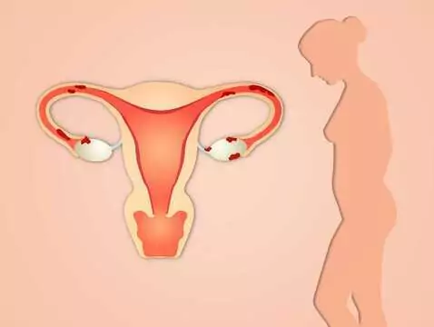 Neoplasia intraepitelial cervical (NIC)