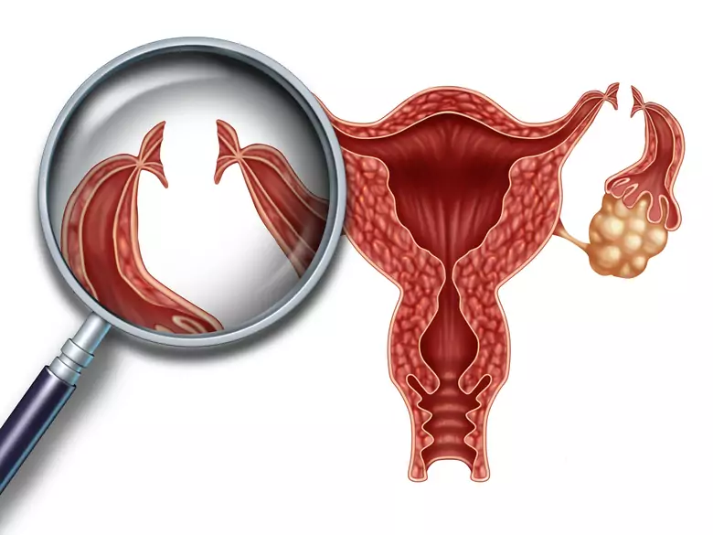 ¿Nueva prueba para detectar precozmente el cáncer de ovario?