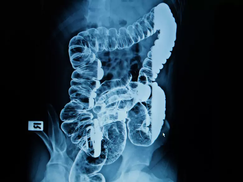 Nutrición enteral para pacientes con cáncer