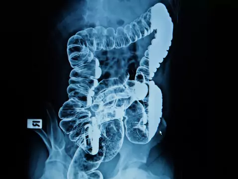 Cáncer colorrectal - causas, síntomas, diagnóstico, tratamiento