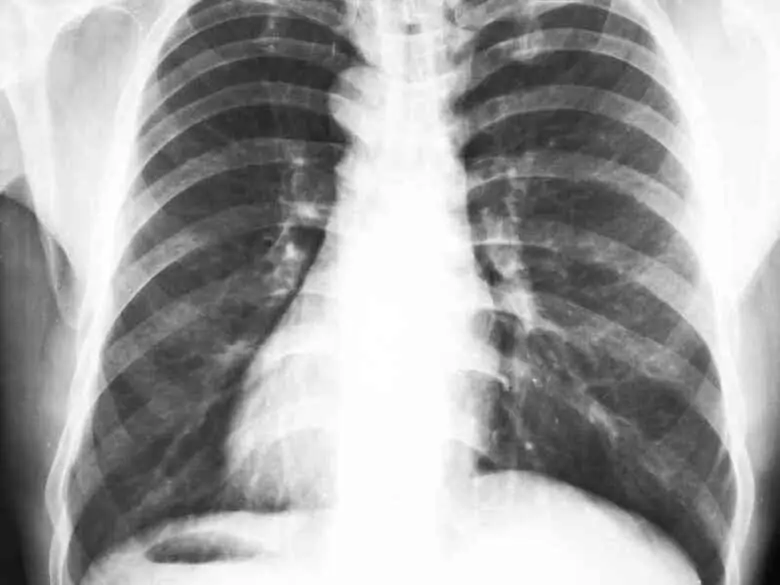 Pecho de pollo - causas, síntomas, diagnóstico, tratamiento