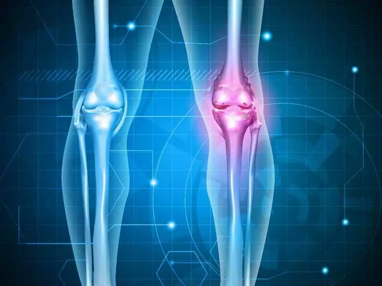 Pegar huesos rotos: ¿es posible?