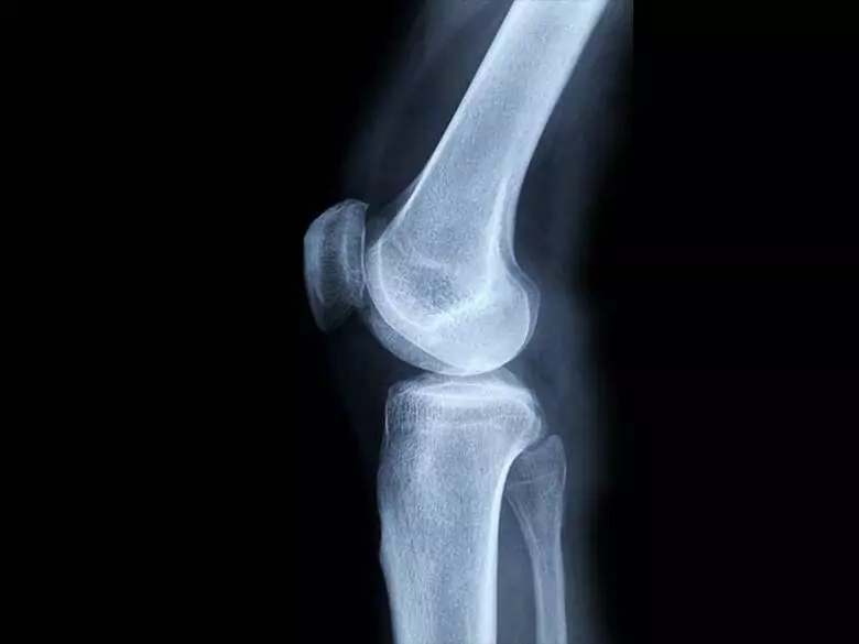 Tumor óseo maligno - causas y factores de riesgo