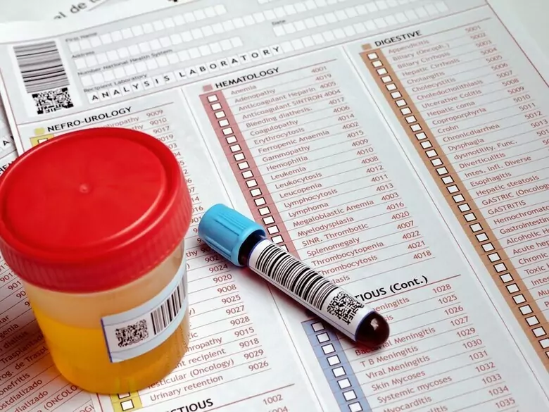 ¿Qué significa un nivel elevado de ácido úrico?