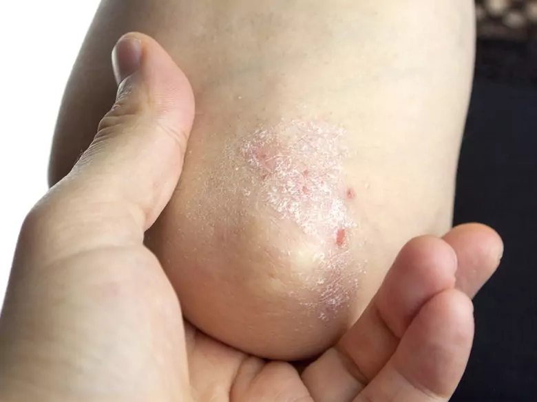 ¡Una pomada utilizada por los enfermos de psoriasis desaparecerá de las estanterías de las farmacias!