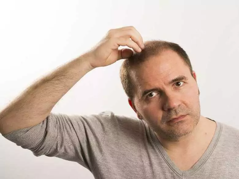 ¿Qué es la alopecia y cómo se trata?