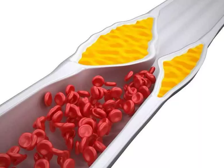 Hipercolesterolemia familiar: cuando un niño tiene un nivel de colesterol demasiado alto