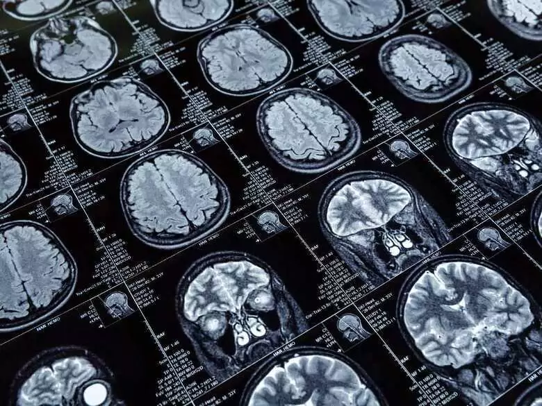 Secuelas más frecuentes del ictus isquémico