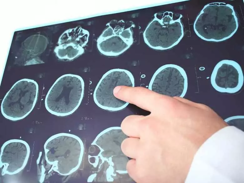 Paraplejías espásticas: ¿qué son?