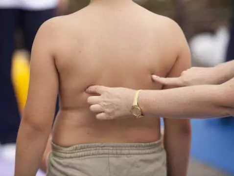 Aterosclerosis e infarto de miocardio en niños: ¿es posible?