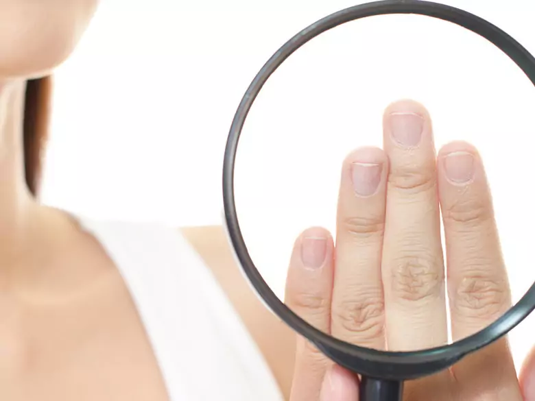 Uñas partidas y cutículas que se despegan