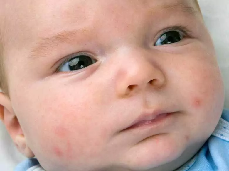 Alergia alimentaria frente a sarpullido: ¿qué deben saber todos los padres?