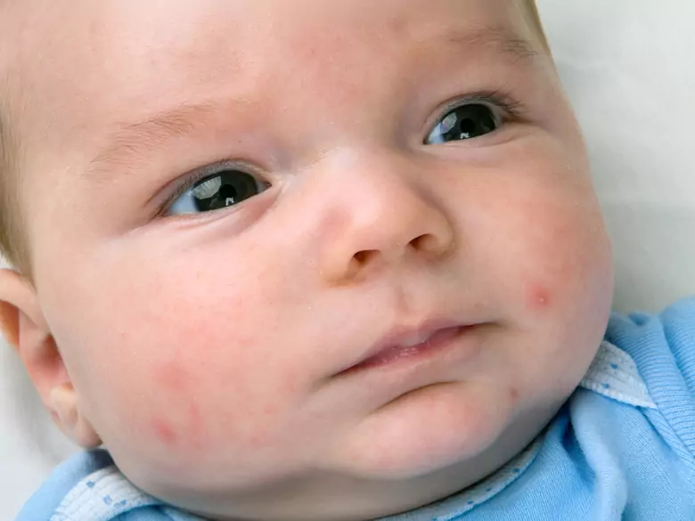 Alergia alimentaria frente a sarpullido: ¿qué deben saber todos los padres?