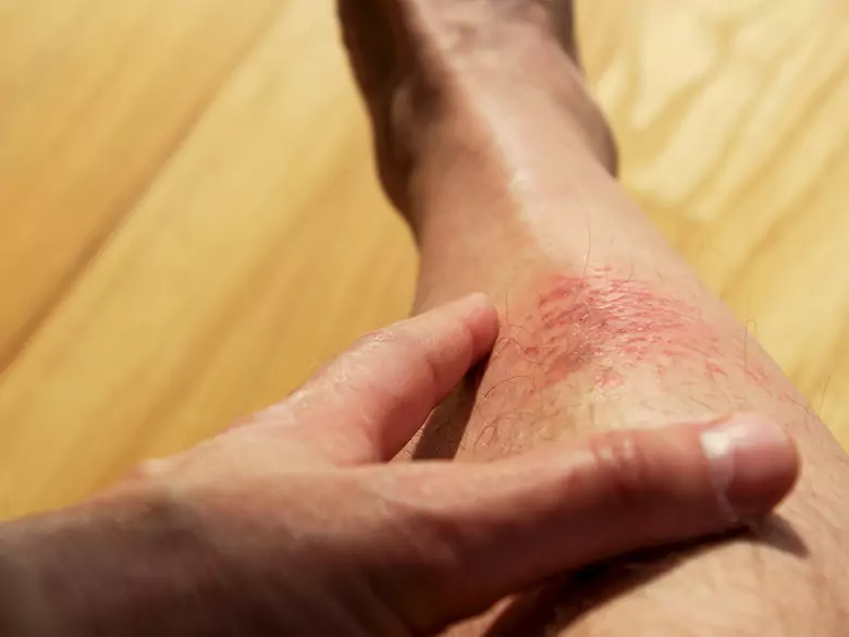 Pioderma gangrenoso: ¿qué es?