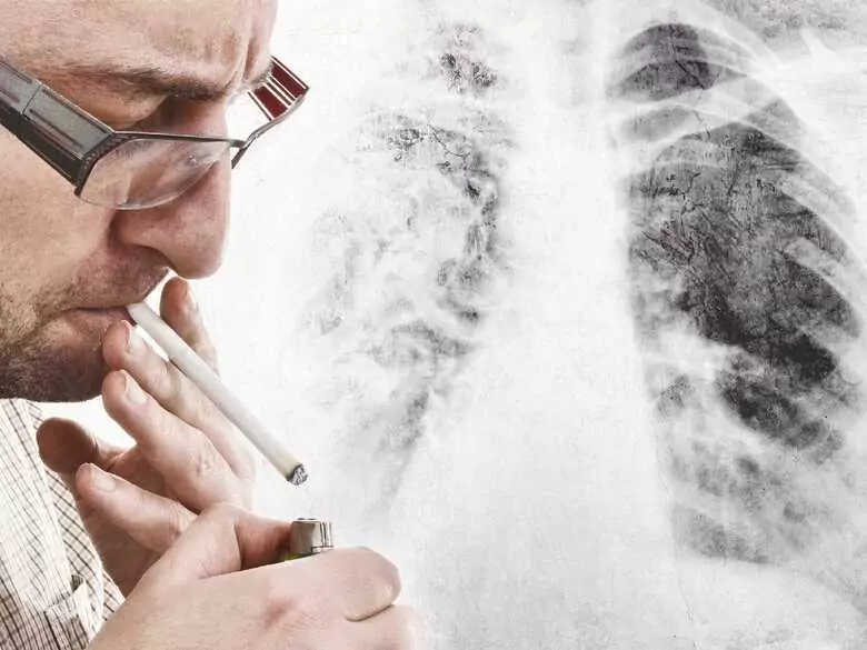 ¿Qué tipo de tos sugiere un cáncer de pulmón?