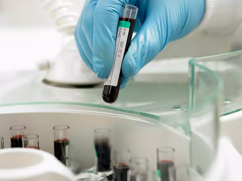 Anemia en el embarazo - causas, síntomas, diagnóstico, tratamiento