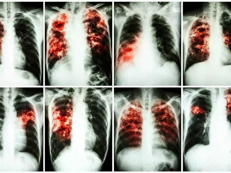 Científicos checos han inventado un nuevo fármaco contra la tuberculosis
