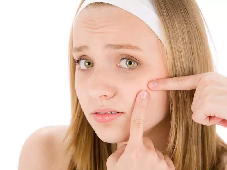 Patogénesis y tratamiento del acné vulgar