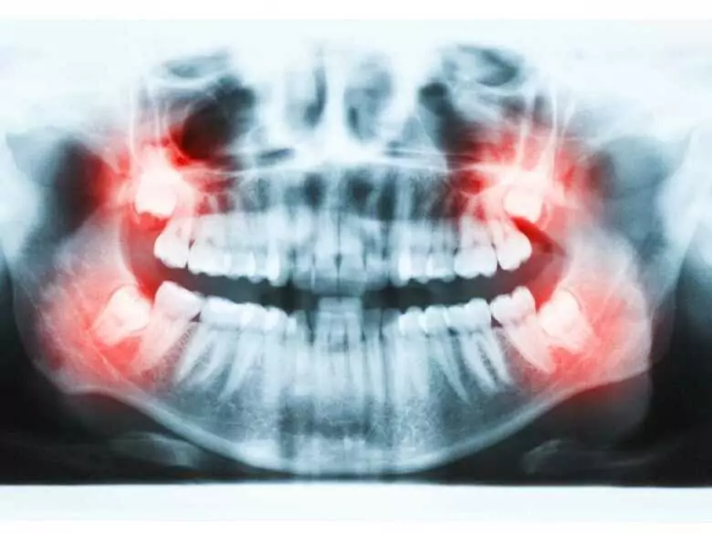 La robótica en el tratamiento de dientes fracturados