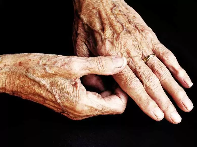 Estimulación del nervio vago y tratamiento de la AR