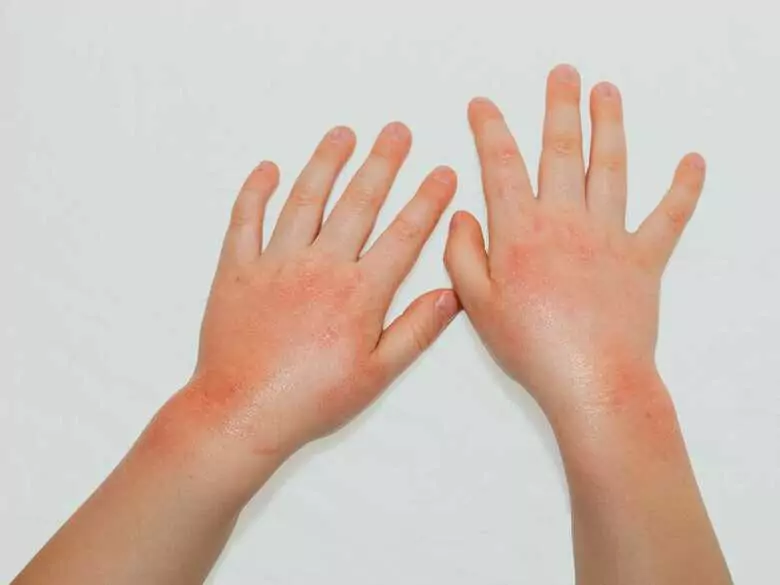 ¿Existen remedios caseros para la urticaria?