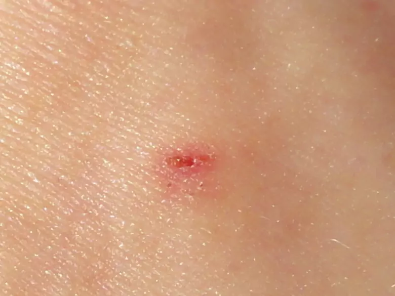 Las revisiones periódicas de los nevus pueden salvar vidas