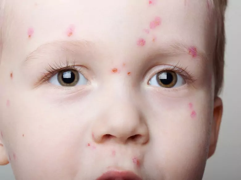 Varicela - infecciosidad para el medio ambiente