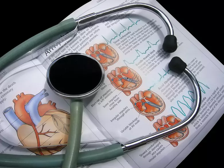 Endocarditis infecciosa