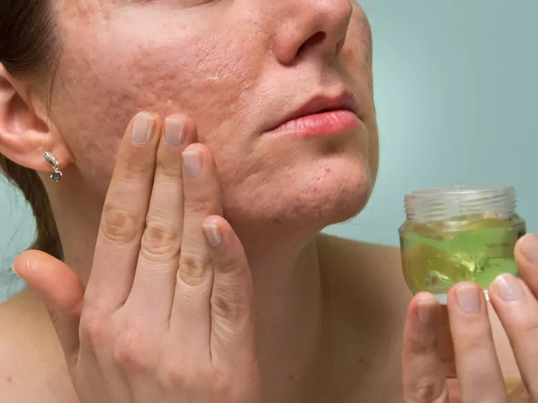 Formas de eliminar las cicatrices