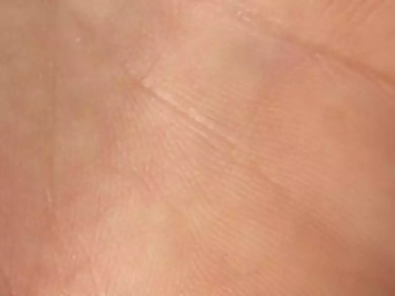 Nevus plano vascular