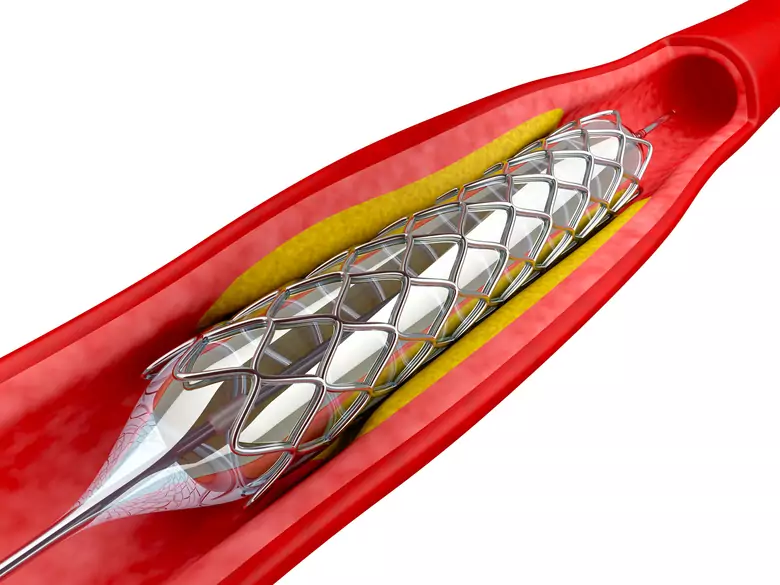 Aneurisma aórtico - causas, síntomas, diagnóstico, tratamiento