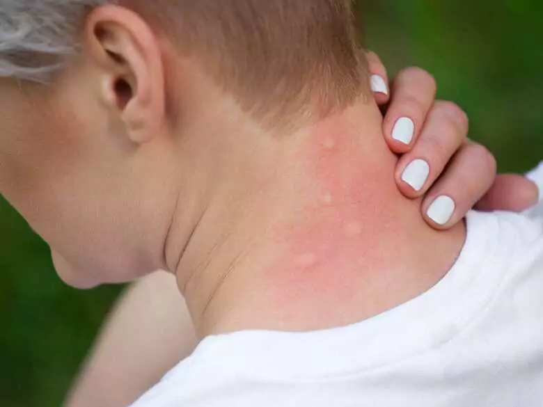 Tratamiento de la dermatitis seborreica - nuevos conocimientos